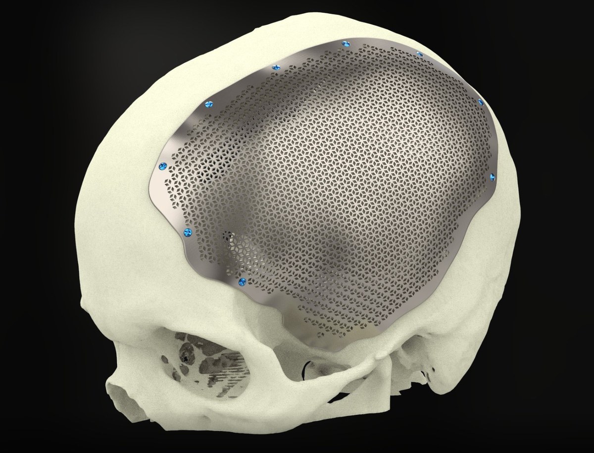 Cranial implant geprint met SLM-poederbed, titanium met fijne hexagonal lattice voor osteo-integratie